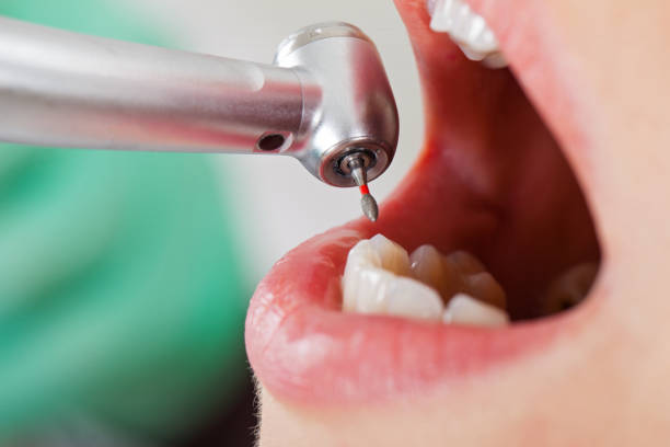 Best Emergency Wisdom Teeth Removal in Lyford, TX